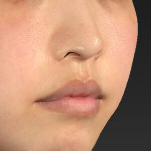 新宿ラクル美容外科クリニック　山本厚志　「人中短縮術（リップリフト）＋口角挙上（スマイルリップ）」　手術前　４月１９日