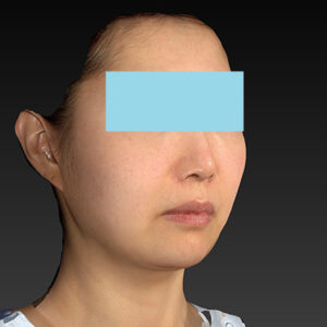 新宿ラクル美容外科クリニック　山本厚志　ナチュラルフェイスネックリフト　手術前　４月２０日