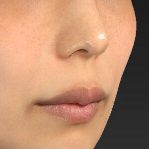 新宿ラクル美容外科クリニック　山本厚志　「人中短縮術（リップリフト）」　手術前　４月２１日