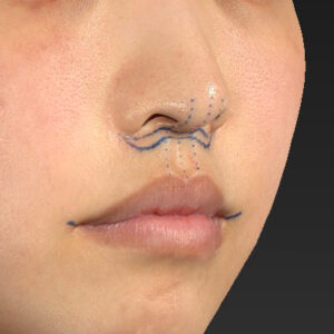 新宿ラクル美容外科クリニック　山本厚志　「人中短縮術（リップリフト）＋口角挙上（スマイルリップ）」　デザイン　４月１９日