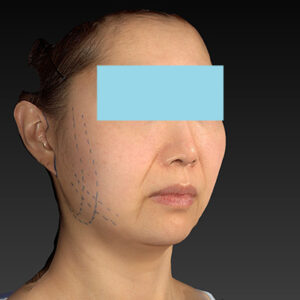 新宿ラクル美容外科クリニック　山本厚志　ナチュラルフェイスネックリフト　デザイン　４月２０日