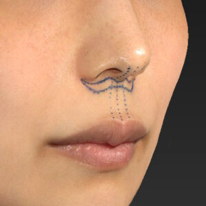 新宿ラクル美容外科クリニック　山本厚志　「人中短縮術（リップリフト）」　デザイン　４月２１日