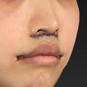 新宿ラクル美容外科クリニック　山本厚志　「人中短縮術（リップリフト）＋口角挙上（スマイルリップ）」　手術直後　４月１９日