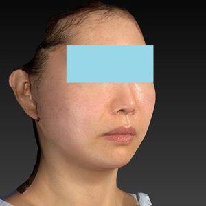 新宿ラクル美容外科クリニック　山本厚志　ナチュラルフェイスネックリフト　手術直後　４月２０日