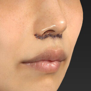 新宿ラクル美容外科クリニック　山本厚志　「人中短縮術（リップリフト）」　手術直後　４月２１日