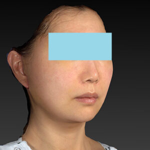 新宿ラクル美容外科クリニック　山本厚志　ナチュラルフェイスネックリフト　手術後１週間目　４月２０日