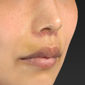 新宿ラクル美容外科クリニック　山本厚志　「人中短縮術（リップリフト）」　手術後１週間目　４月２１日