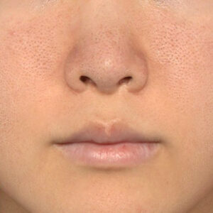 
新宿ラクル美容外科クリニック　山本厚志　「猫手術（鼻唇角形成術）+ 貴族手術（鼻翼基部プロテーゼ）」　手術後１２ヶ月目　１０月９日

