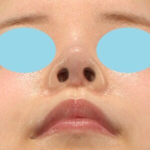 「鼻中隔延長修正＋耳介軟骨移植修正＋鼻尖形成修正＋小鼻縮小＋α法修正＋鼻柱下降＋猫手術＋真皮脂肪移植（鼻尖）」　新宿ラクル美容外科クリニック　２０代女性　手術後１２ヶ月目　４月２４日