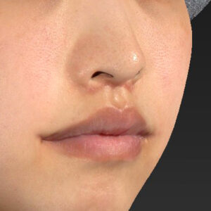 新宿ラクル美容外科クリニック　山本厚志　「人中短縮術（リップリフト）＋口角挙上（スマイルリップ）」　手術後１ヶ月目　４月１９日