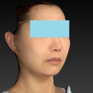 新宿ラクル美容外科クリニック　山本厚志　ナチュラルフェイスネックリフト　手術後１ヶ月目　４月２０日