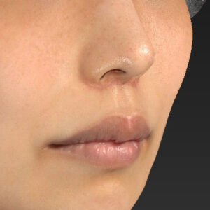 新宿ラクル美容外科クリニック　山本厚志　「人中短縮術（リップリフト）」　手術後１ヶ月目　４月２１日