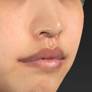 新宿ラクル美容外科クリニック　山本厚志　「人中短縮術（リップリフト）＋口角挙上（スマイルリップ）」　手術後２ヶ月目　４月１９日