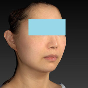 新宿ラクル美容外科クリニック　山本厚志　ナチュラルフェイスネックリフト　手術後２ヶ月目　４月２０日