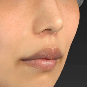 新宿ラクル美容外科クリニック　山本厚志　「人中短縮術（リップリフト）」　手術後２ヶ月目　４月２１日