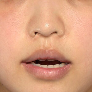 新宿ラクル美容外科クリニック　山本厚志　「人中短縮術（リップリフト）＋口角挙上（スマイルリップ）」　手術前　４月１９日