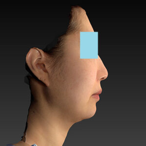 新宿ラクル美容外科クリニック　山本厚志　ナチュラルフェイスネックリフト　手術前　４月２０日