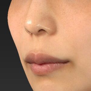 新宿ラクル美容外科クリニック　山本厚志　「人中短縮術（リップリフト）」　手術前　４月２１日