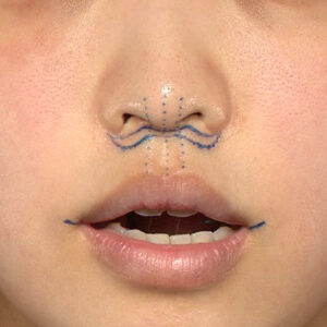 新宿ラクル美容外科クリニック　山本厚志　「人中短縮術（リップリフト）＋口角挙上（スマイルリップ）」　デザイン　４月１９日