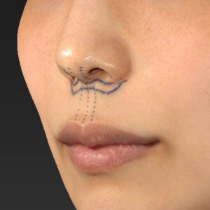 新宿ラクル美容外科クリニック　山本厚志　「人中短縮術（リップリフト）」　デザイン　４月２１日