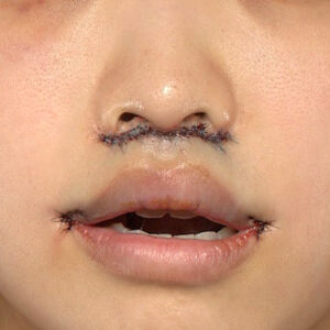 新宿ラクル美容外科クリニック　山本厚志　「人中短縮術（リップリフト）＋口角挙上（スマイルリップ）」　手術直後　４月１９日