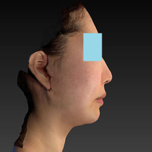 新宿ラクル美容外科クリニック　山本厚志　ナチュラルフェイスネックリフト　手術直後　４月２０日