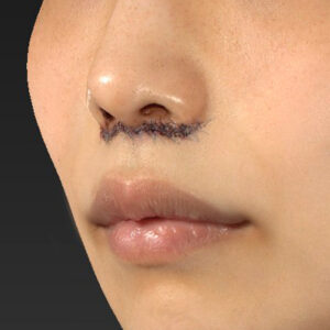 新宿ラクル美容外科クリニック　山本厚志　「人中短縮術（リップリフト）」　手術直後　４月２１日