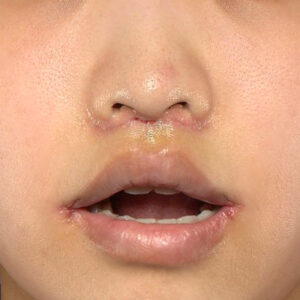 新宿ラクル美容外科クリニック　山本厚志　「人中短縮術（リップリフト）＋口角挙上（スマイルリップ）」　手術後１週間目　４月１９日