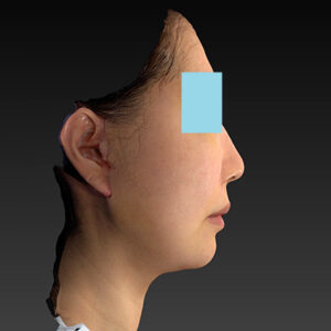 新宿ラクル美容外科クリニック　山本厚志　ナチュラルフェイスネックリフト　手術後１週間目　４月２０日