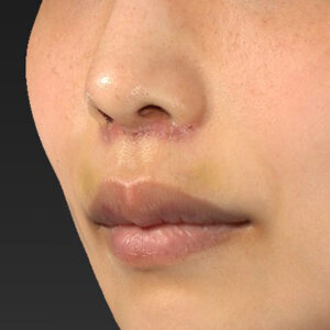 新宿ラクル美容外科クリニック　山本厚志　「人中短縮術（リップリフト）」　手術後１週間目　４月２１日