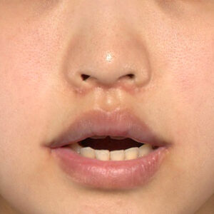 新宿ラクル美容外科クリニック　山本厚志　「人中短縮術（リップリフト）＋口角挙上（スマイルリップ）」　手術後１ヶ月目　４月１９日