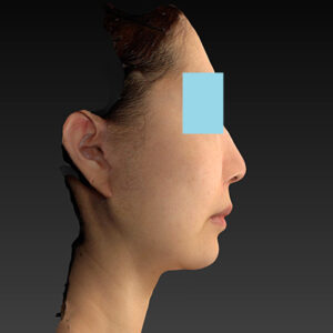 新宿ラクル美容外科クリニック　山本厚志　ナチュラルフェイスネックリフト　手術後１ヶ月目　４月２０日