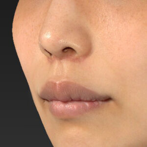 新宿ラクル美容外科クリニック　山本厚志　「人中短縮術（リップリフト）」　手術後１ヶ月目　４月２１日