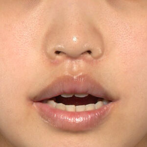 新宿ラクル美容外科クリニック　山本厚志　「人中短縮術（リップリフト）＋口角挙上（スマイルリップ）」　手術後２ヶ月目　４月１９日