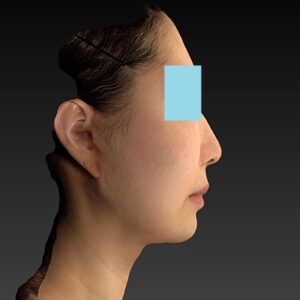 新宿ラクル美容外科クリニック　山本厚志　ナチュラルフェイスネックリフト　手術後２ヶ月目　４月２０日