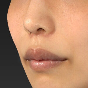 新宿ラクル美容外科クリニック　山本厚志　「人中短縮術（リップリフト）」　手術後２ヶ月目　４月２１日