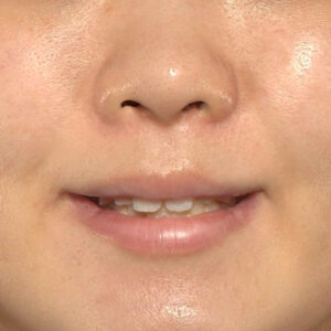 新宿ラクル美容外科クリニック　山本厚志　「猫手術（鼻唇角形成術）+ 貴族手術（鼻翼基部プロテーゼ）」　手術後６ヶ月目　６月８日