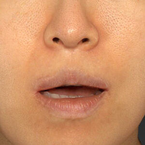 新宿ラクル美容外科クリニック　山本厚志　「外側人中短縮術（上口唇挙上術）修正 + 口角挙上（スマイルリフト）修正」　手術後６ヶ月目　４月８日