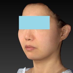 新宿ラクル美容外科クリニック　山本厚志　ナチュラルフェイスネックリフト　手術前　４月２０日