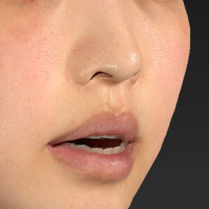 新宿ラクル美容外科クリニック　山本厚志　「人中短縮術（リップリフト）＋口角挙上（スマイルリップ）」　手術前　４月１９日