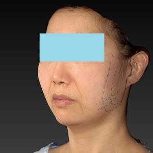 新宿ラクル美容外科クリニック　山本厚志　ナチュラルフェイスネックリフト　デザイン　４月２０日