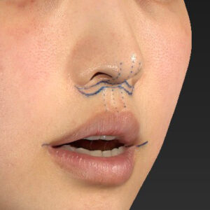 新宿ラクル美容外科クリニック　山本厚志　「人中短縮術（リップリフト）＋口角挙上（スマイルリップ）」　デザイン　４月１９日