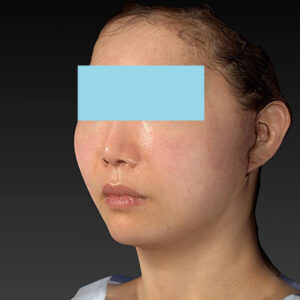 新宿ラクル美容外科クリニック　山本厚志　ナチュラルフェイスネックリフト　手術直後　４月２０日