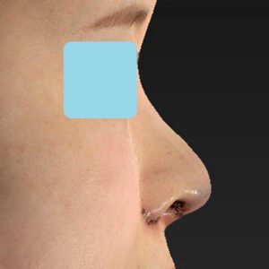 「鼻中隔延長修正＋耳介軟骨移植修正＋鼻尖形成修正＋小鼻縮小＋α法修正＋鼻柱下降＋猫手術＋真皮脂肪移植（鼻尖）」　新宿ラクル美容外科クリニック　２０代女性　手術直後　７月６日