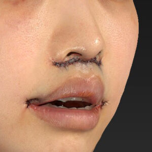 新宿ラクル美容外科クリニック　山本厚志　「人中短縮術（リップリフト）＋口角挙上（スマイルリップ）」　手術直後　４月１９日