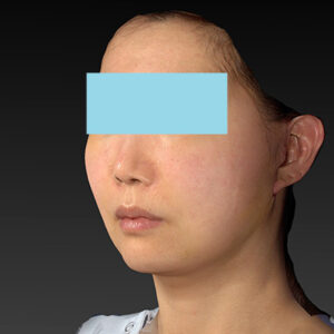 新宿ラクル美容外科クリニック　山本厚志　ナチュラルフェイスネックリフト　手術後１週間目　４月２０日