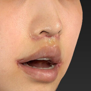 新宿ラクル美容外科クリニック　山本厚志　「人中短縮術（リップリフト）＋口角挙上（スマイルリップ）」　手術後１週間目　４月１９日