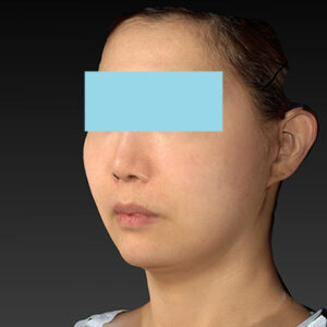 新宿ラクル美容外科クリニック　山本厚志　ナチュラルフェイスネックリフト　手術後１ヶ月目　４月２０日