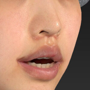 新宿ラクル美容外科クリニック　山本厚志　「人中短縮術（リップリフト）＋口角挙上（スマイルリップ）」　手術後１ヶ月目　４月１９日