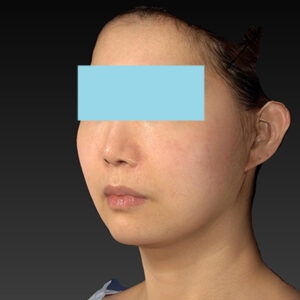 新宿ラクル美容外科クリニック　山本厚志　ナチュラルフェイスネックリフト　手術後２ヶ月目　４月２０日